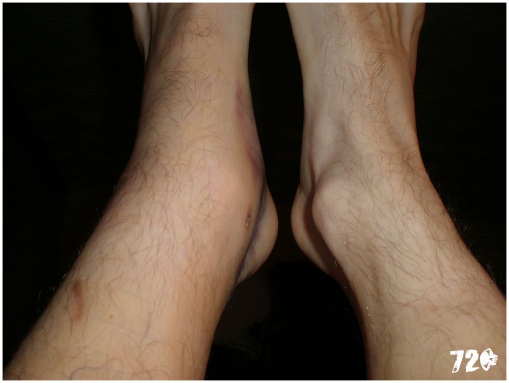broken ancle (1).JPG