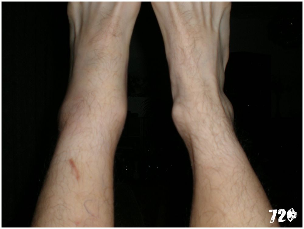 broken ancle (3).JPG