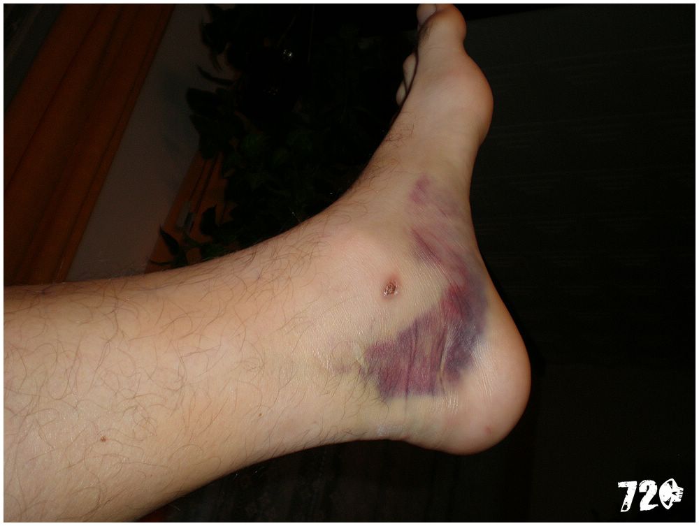 broken ancle (4).JPG