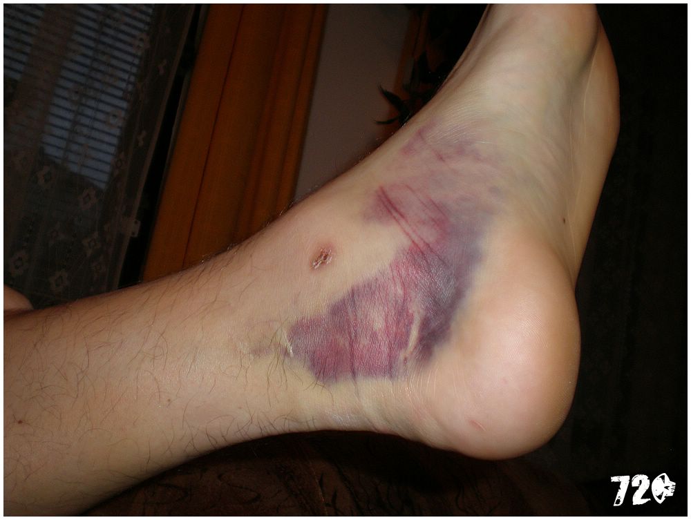 broken ancle (5).JPG